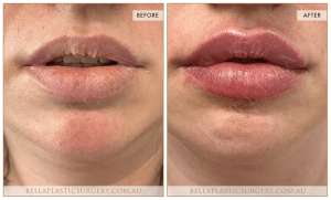 ‘Kiss Me’ Lip Augmentation 02 - 3