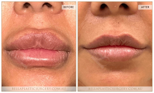'Kiss Me' Lip Augmentation 07 - 8