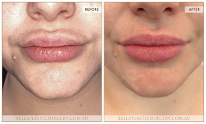 'Kiss Me' Lip Augmentation 08 - 9