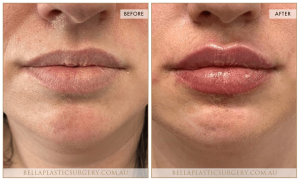 'Kiss Me' Lip Augmentation 09 - 10
