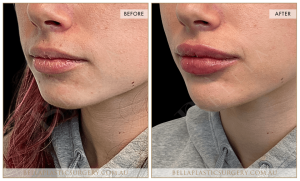 Lower Face Treatment 03 - 4