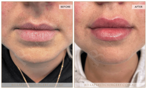 ‘Kiss Me’ Lip Augmentation 03 - 4