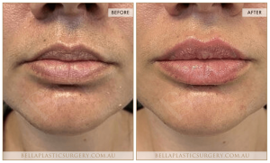 ‘Kiss Me’ Lip Augmentation 04 - 5