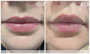 'Kiss Me' Lip Augmentation 05 - 6