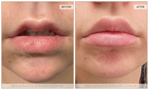 'Kiss Me' Lip Augmentation 06 - 7