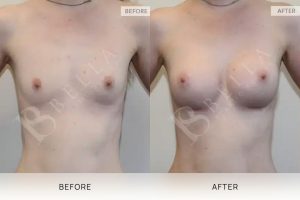 Breast Augmentation 11 - 10