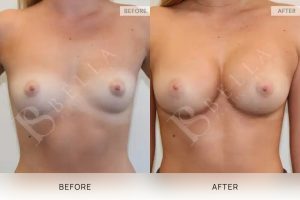 Breast Augmentation 12 - 11