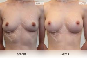Breast Augmentation 13 - 12