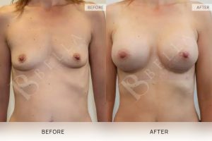 Breast Augmentation 15 - 14
