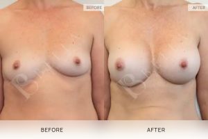Breast Augmentation 16 - 15