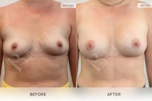 Breast Augmentation 17 - 16