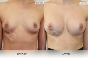 Breast Augmentation 19 - 18