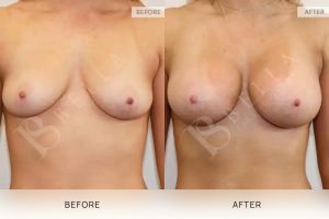 Breast Augmentation 20 - 19