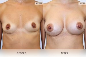 Breast Augmentation 03 - 2