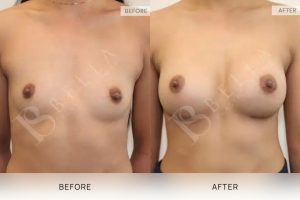Breast Augmentation 21 - 20