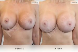 Breast Augmentation 22 - 21