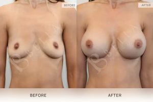 Breast Augmentation 23 - 22
