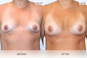 Breast Augmentation 04 - 3