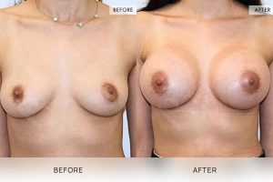 Breast Augmentation 05 - 4
