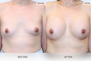 Breast Augmentation 06 - 5