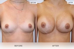 Breast Augmentation 07 - 6