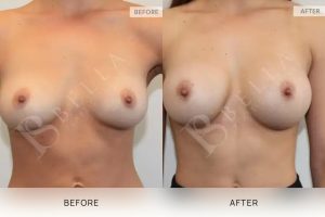 Breast Augmentation 08 - 7