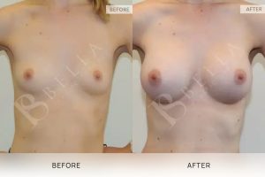 Breast Augmentation 09 - 8