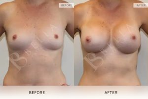 Breast Augmentation 10 - 9