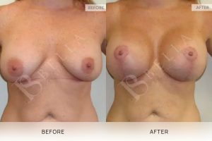 Breast Lift (Mastopexy) + Implants Patient 05 - 5