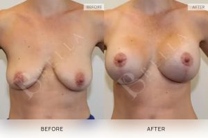 Breast Lift (Mastopexy) + Implants Patient 06 - 6