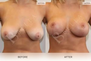 Breast Lift (Mastopexy) + Implants Patient 08 - 8