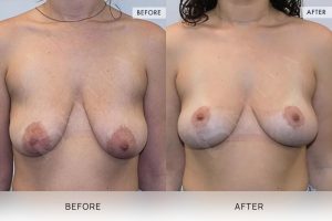 Breast Lift Patient 01 - 2