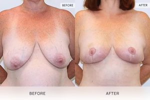 Breast Lift Patient 04 - 5