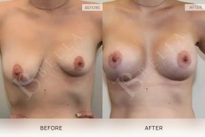 Breast Lift Patient 07 - 8