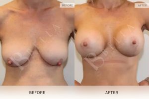 Breast Lift Patient 08 - 9