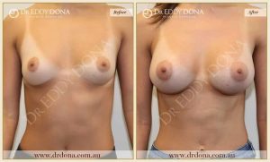 Breast Augmentation 37 - 36