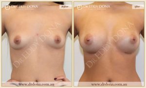 Breast Augmentation 38 - 37