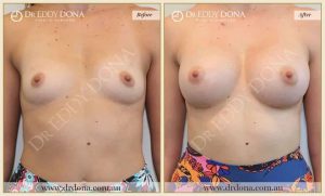 Breast Augmentation 39 - 38