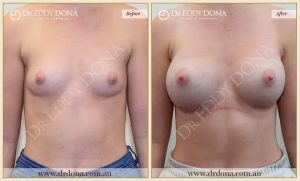 Breast Augmentation 24 - 23