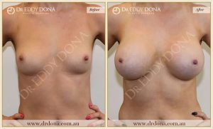 Breast Augmentation 48 - 47
