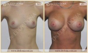 Breast Augmentation 25 - 24
