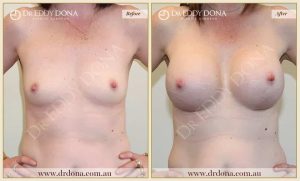 Breast Augmentation 26 - 25