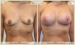Breast Augmentation 42 - 41