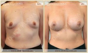 Breast Augmentation 43 - 42