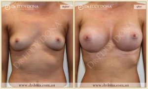 Breast Augmentation 41 - 40