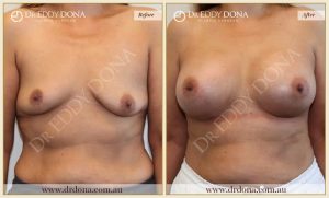 Breast Augmentation 47 - 46