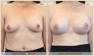 Breast Augmentation 45 - 44