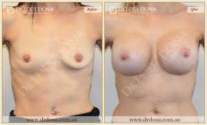 Breast Augmentation 29 - 28
