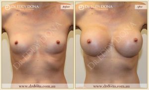 Breast Augmentation 28 - 27