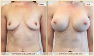 Breast Augmentation 44 - 43